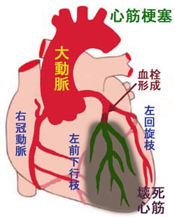 虚血性心疾患（狭心症・心筋梗塞など）