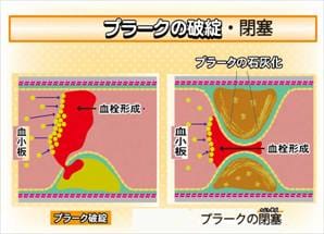 頸動脈エコー