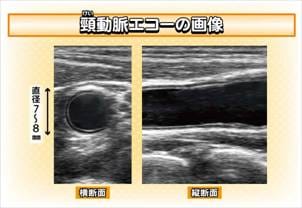 頸動脈エコー