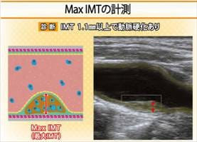 頸動脈エコー