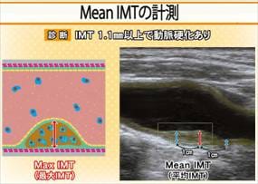 頸動脈エコー