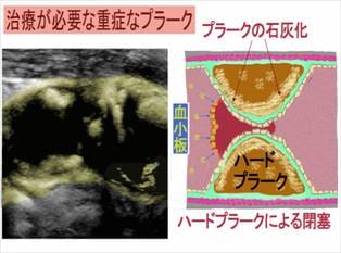 頸動脈エコー